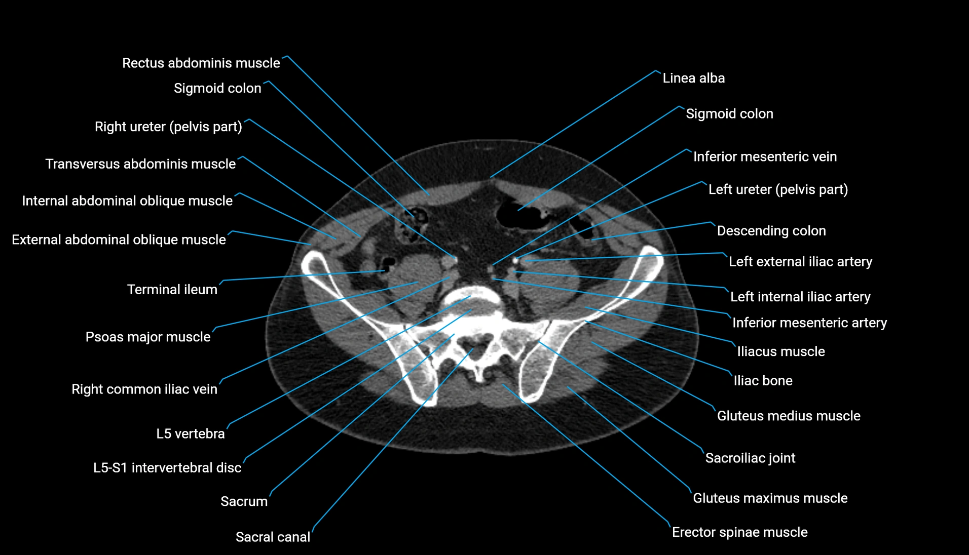 CT urogram axial cross sectional anatomy  labelled radiology image-00180.webp